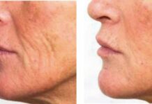 Peeling inverso: soluzione alle macchie da melasma