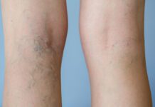 Fragilità capillare: cause e rimedi