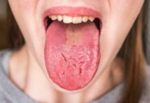 Tagli sulla Lingua: Cause e Rimedi per la Lingua Tagliata