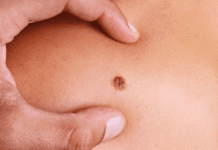 Neo che Prude : quando può trattarsi di melanoma ?