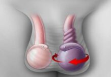 Torsione del Testicolo: Cause e Sintomi