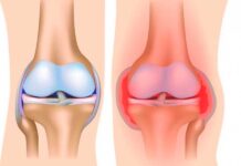 Sinovite: cause, sintomi, trattamento