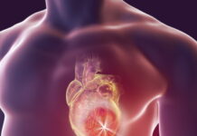 Miocardite: cause, sintomi, trattamento