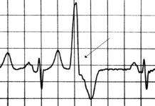 Extrasistole: cause, sintomi, tipi, trattamento