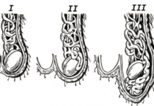 Varicocele: gradi, sintomi, trattamento