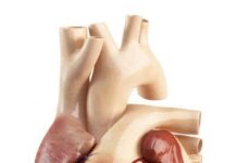 Cardiomiopatia: cause, sintomi, diagnosi, trattamento