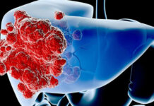 Emangioma del fegato: cause, sintomi, trattamento