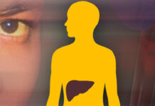 Ittero: cause, sintomi, diagnosi, trattamento